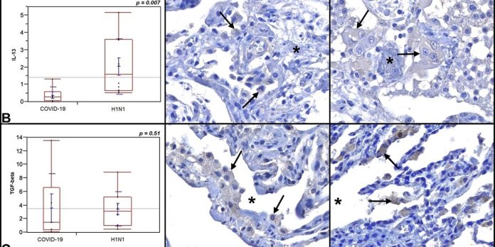 Fibrose cística pode afetar pulmões, pâncreas e fígado, entenda